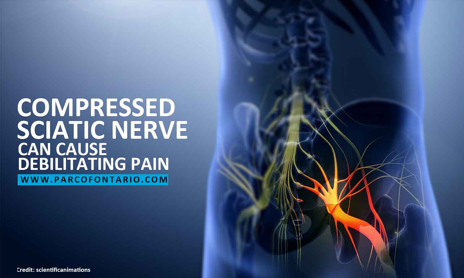 How to Releive Sciatic Nerve Pain