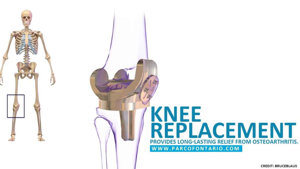 Partial vs Total Knee Replacement Which is the Better Option? The