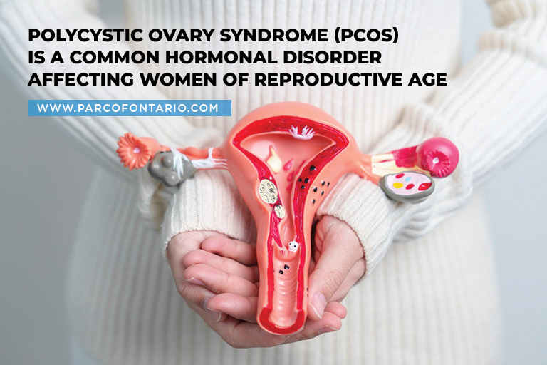 Polycystic Ovary Syndrome (PCOS) is a common hormonal disorder affecting women of reproductive age