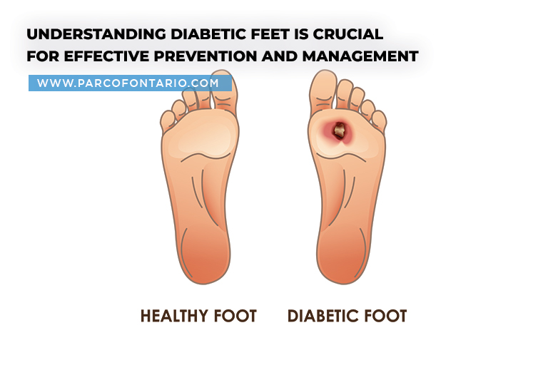 Understanding diabetic feet is crucial for effective prevention and management-01